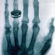 Illustration for article titled This Was The First Human X-Ray Ever Taken